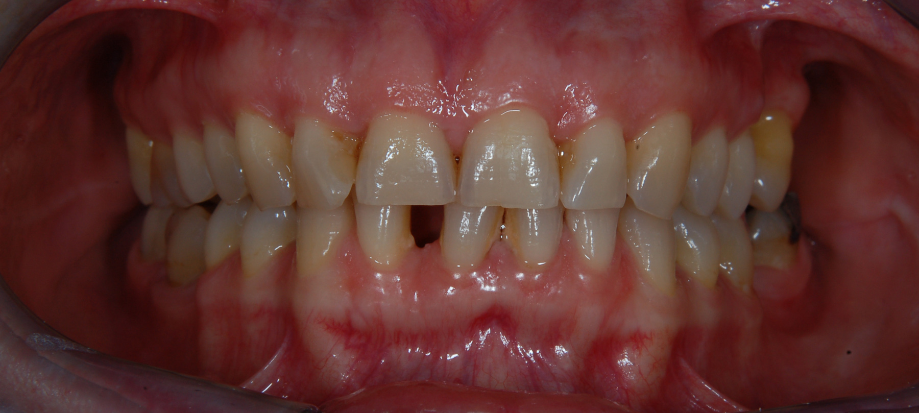 1. Paziente con diastema (spazio interdentale) tra due incisivi inferiori