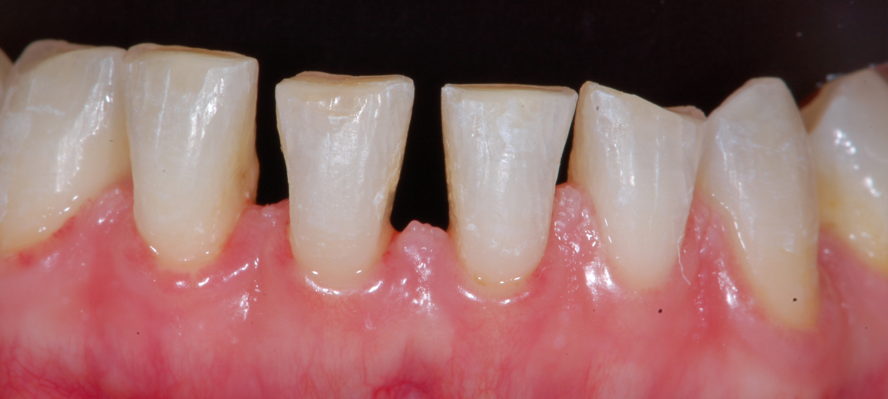 3. Fine della fase ortodontica con gli spazi equamente distribuiti