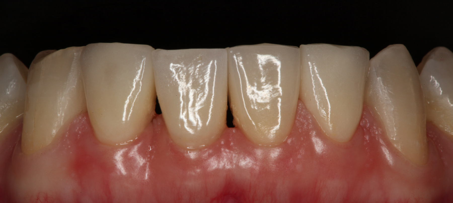 4. Caso terminato con l’inserimento di quattro faccette in ceramica