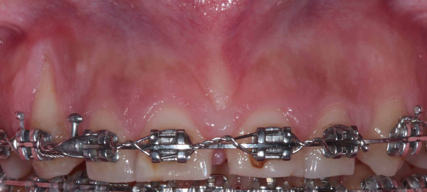 parodontolgia-resettiva-01-1b