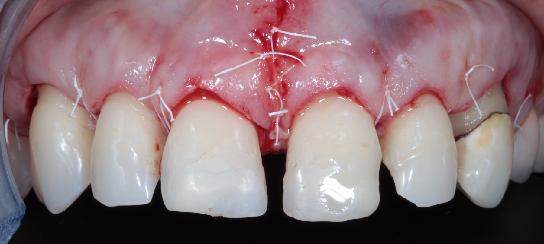 parodontolgia-resettiva-02-03
